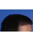 After Hair Transplant&nbsp;2 Sessions (Areas)